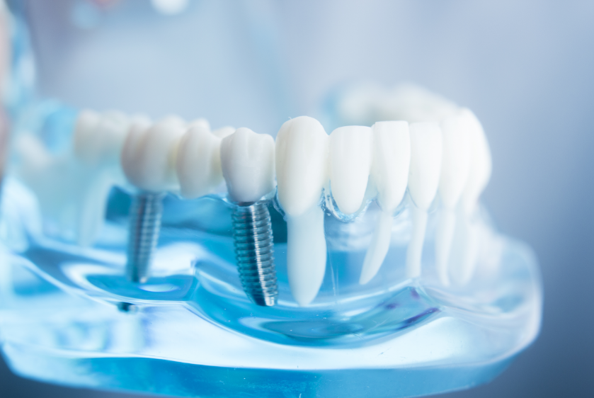 Quels sont les avantages 
de l’implant dentaire ?