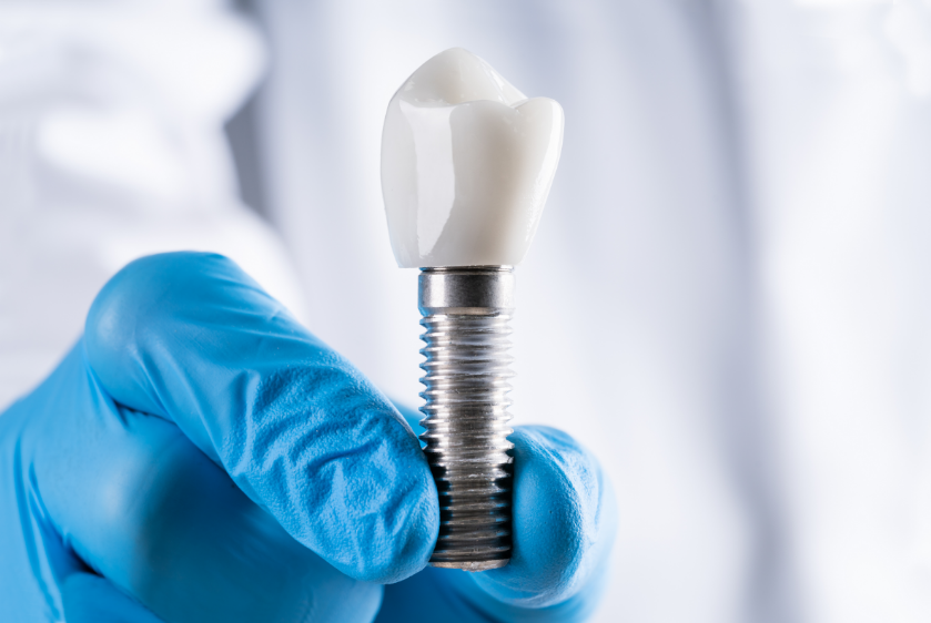 Les implants dentaires : 
que sont-ils ?